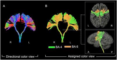 Projections of Brodmann Area 6 to the Pyramidal Tract in Humans: Quantifications Using High Angular Resolution Data